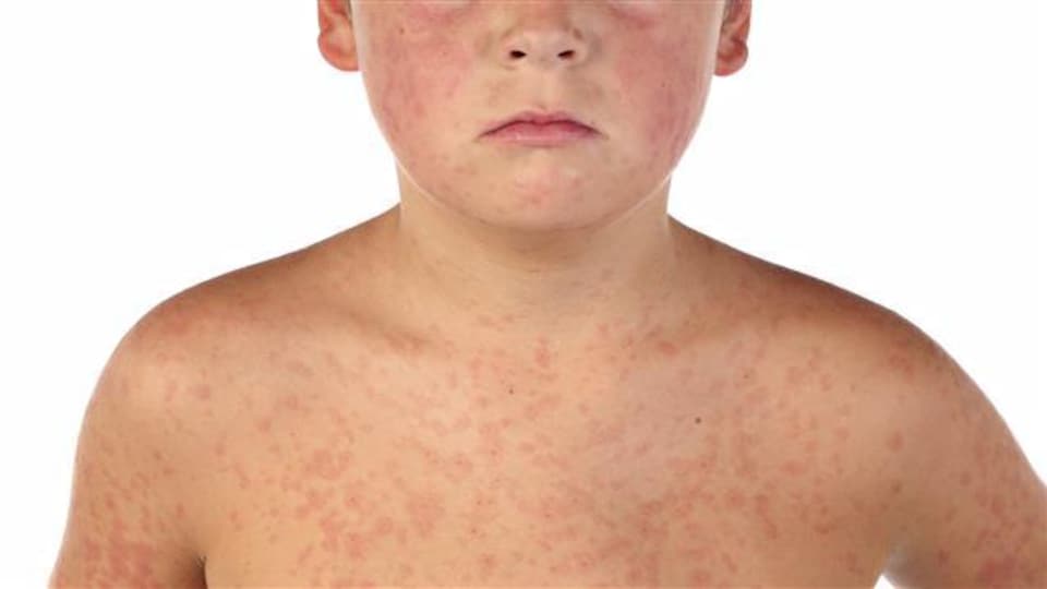 L'apparition de taches rouges sur le corps fait partie des symptômes de la rougeole.