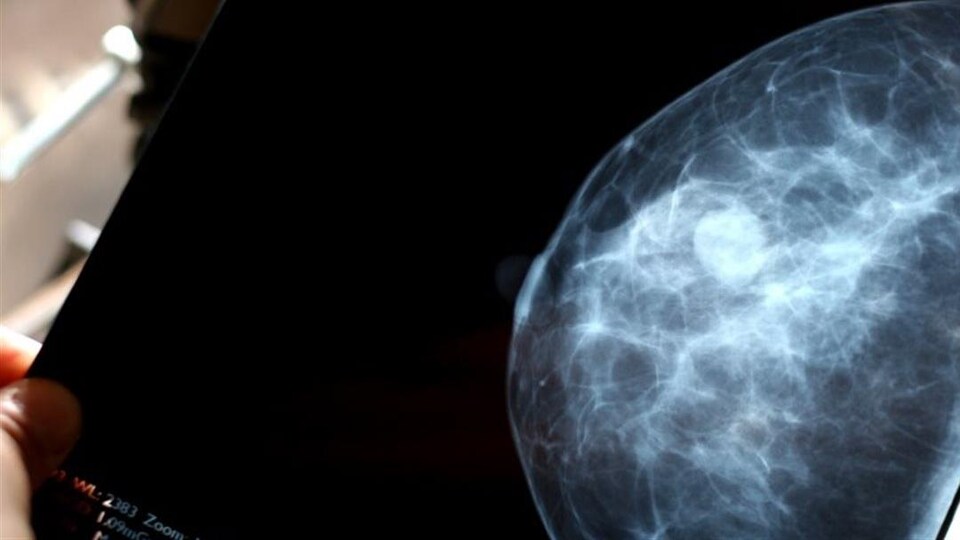 une mammographie. 