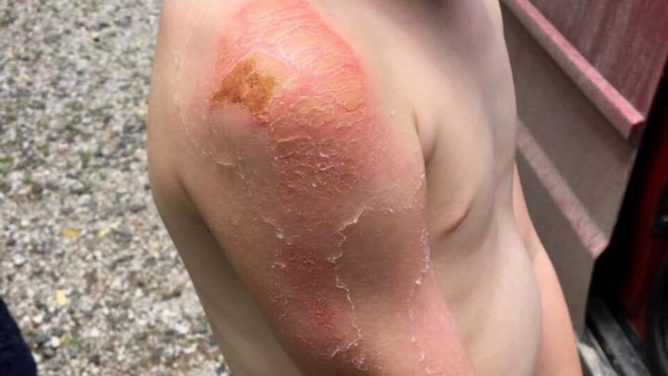 Un enfant a des brûlures graves sur l'épaule.
