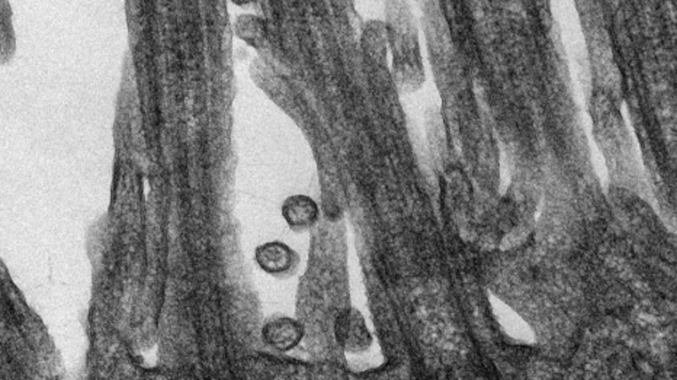 Vue microscopique du SRAS-CoV-2 responsable de la COVID-19 accroché aux cellules épithéliales respiratoires humaines.
