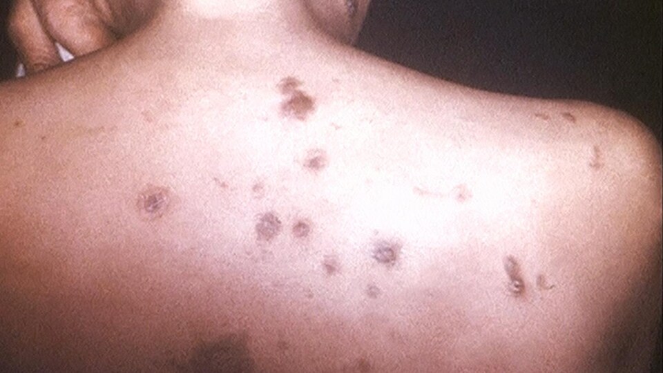 Les éruptions cutanées constituent l'un des symptômes de la syphilis.