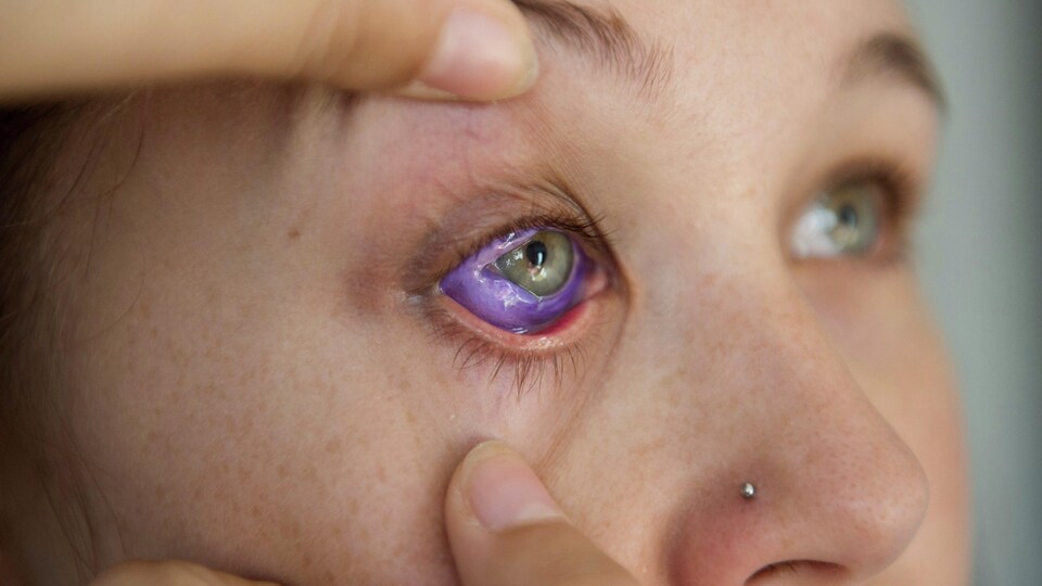 Une jeune femme de 24 ans pourrait avoir des troubles de vision permanents après s'être fait tatouer le globe oculaire.