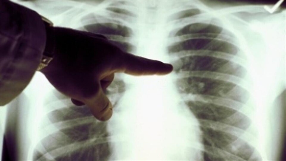 Un doigt pointe un point particulier d'une radiographie des poumons.