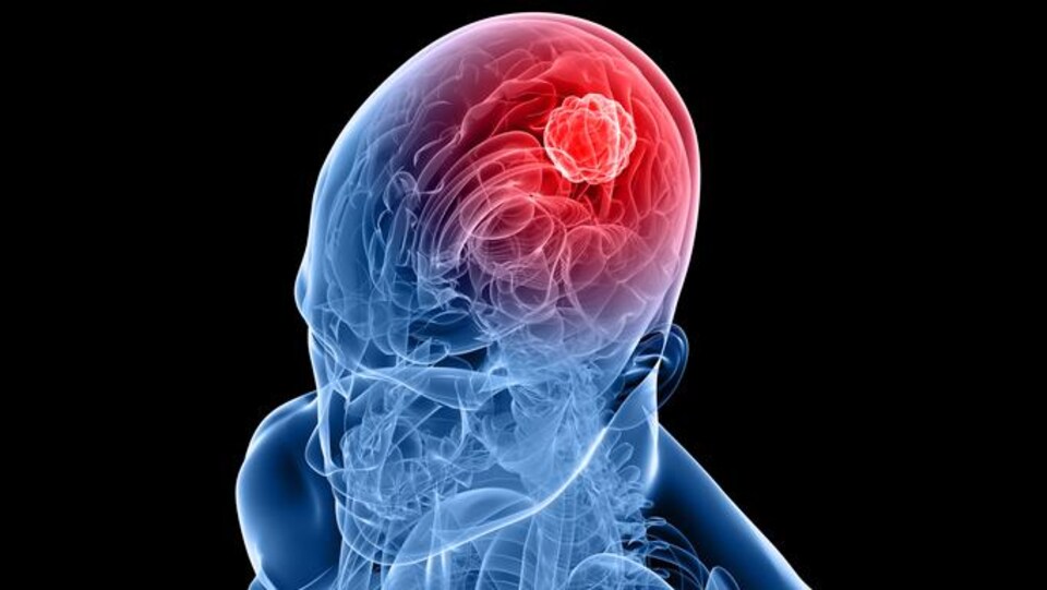 Une radiographie montrant une tumeur du cerveau.
