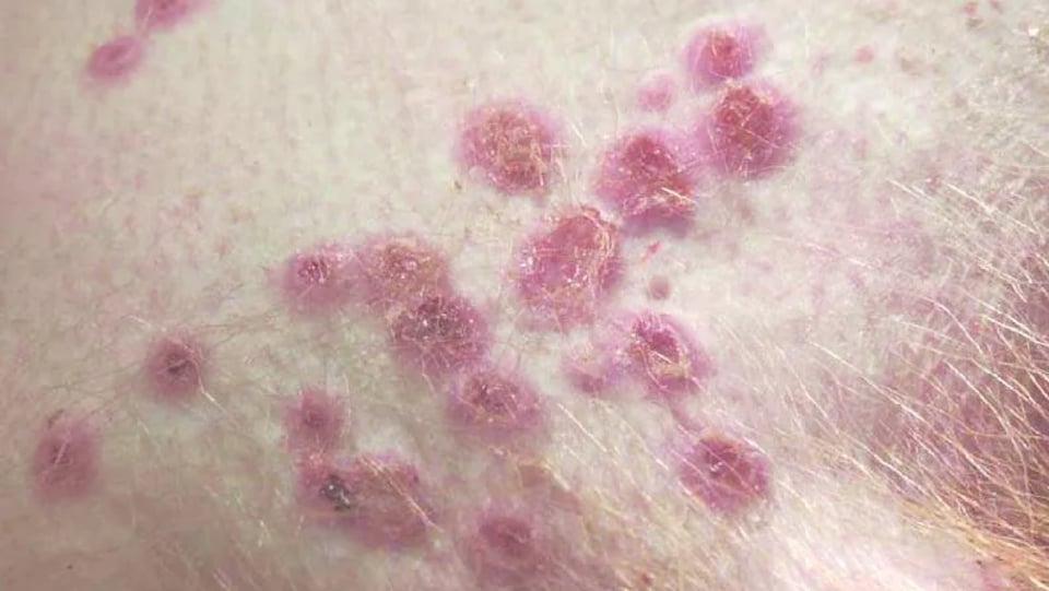 Des éruptions cutanées associées à la variole simienne.