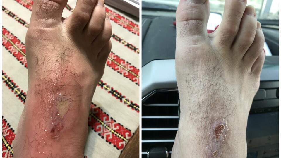 Le pied de Steven Theriault infecté et le même pied guéri 10 jours plus tard.