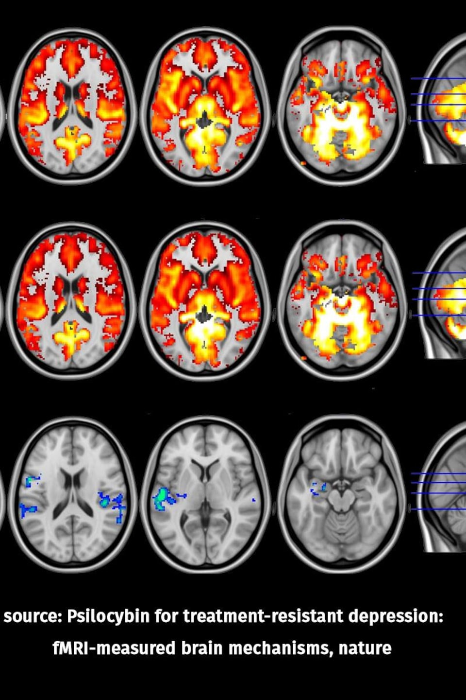 Une copie d'imagerie du cerveau d'un patient atteint de dépression.