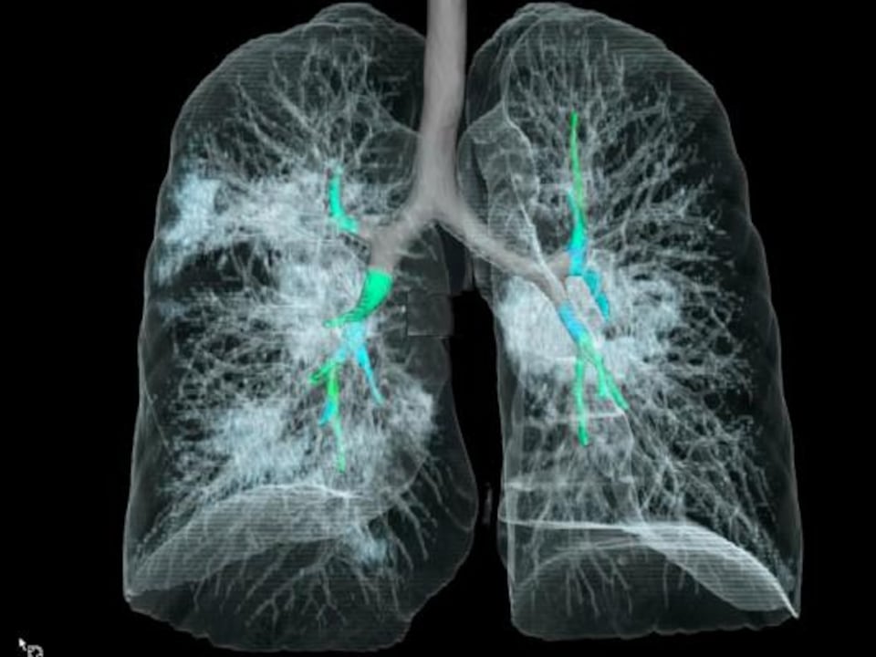 Une tomodensitométrie des poumons d'un homme atteint de COVID-19. 