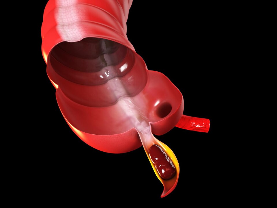 Illustration d'un appendice.