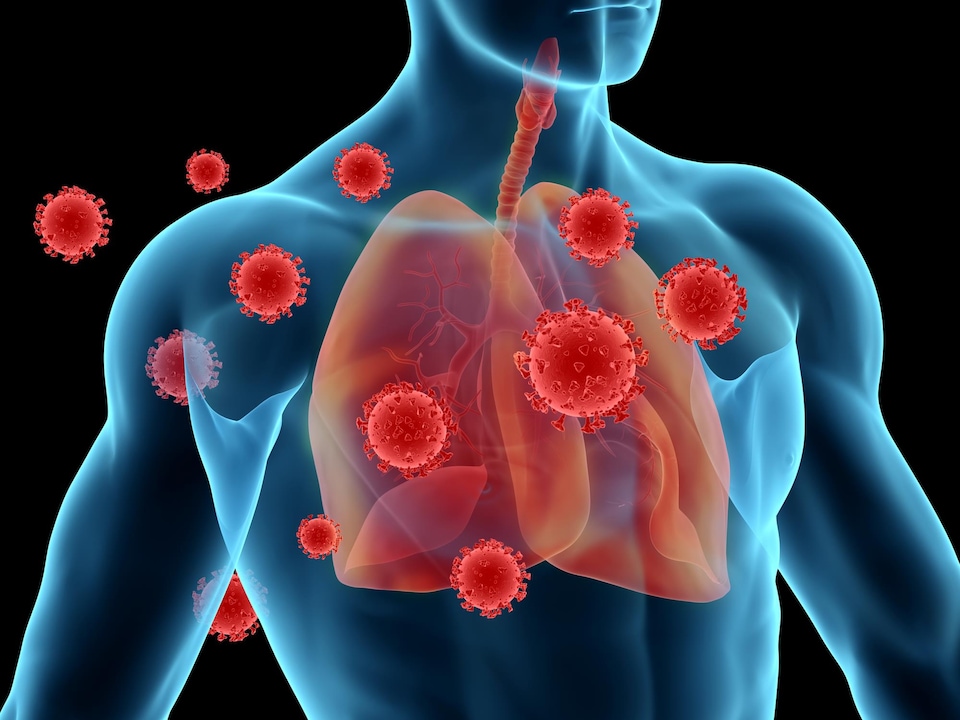 Illustration représentant le corps d'un homme mettant en évidence des poumons infectés par le SRAS-CoV-2, le virus qui cause la COVID-19.