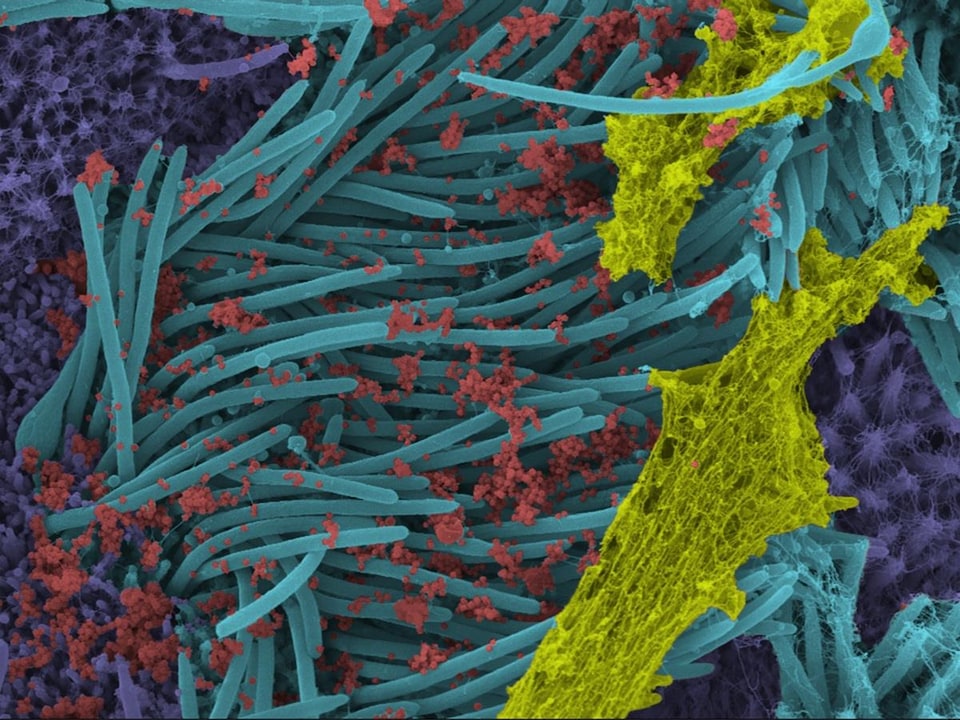 Des Images Saisissantes De Cellules Infectees Par Le Sras Cov 2 Coronavirus Radio Canada Ca