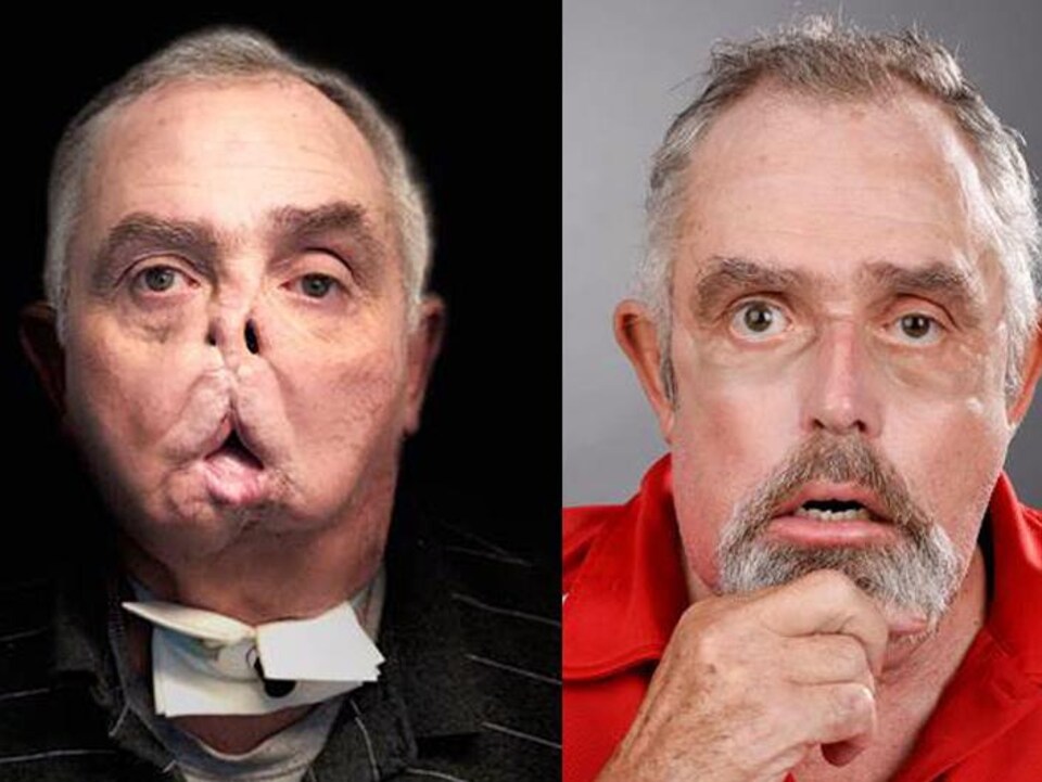 Images d'un homme avant et après une transplantation du visage.