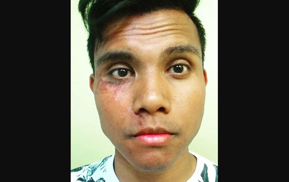 Un jeune homme avec des contusions et des coupure sur une moitié de son visage. 