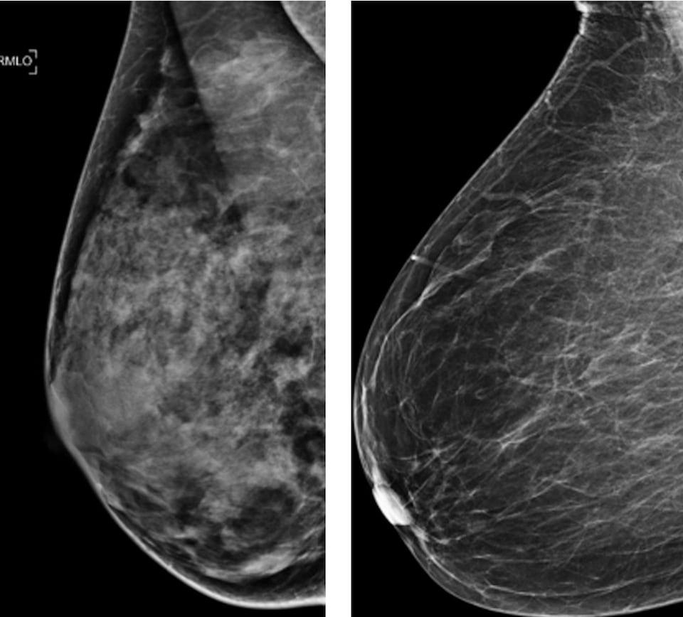 Résultats comparatifs en noir et blanc de mammographies d'un sein très dense et d'un autre moins dense.
