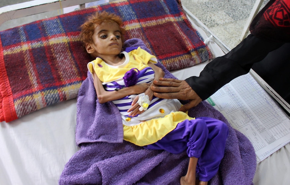 Une enfant atteinte de malnutrition au Yémen.