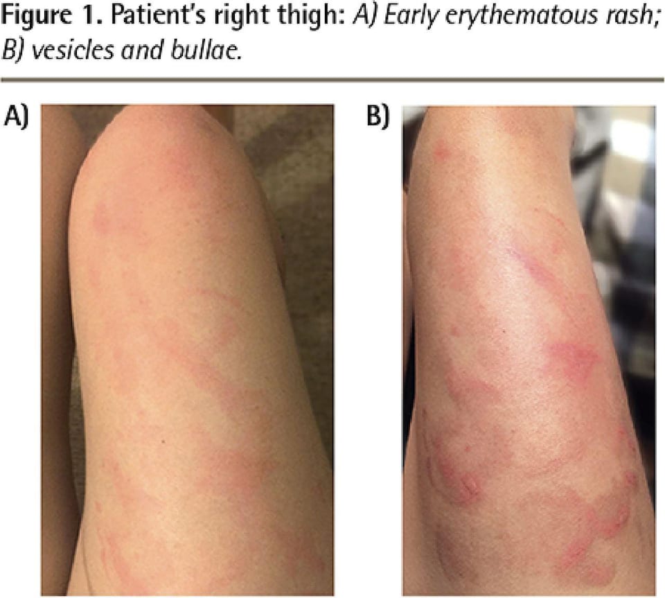 On voit deux photos d'une cuisse de femme recouverte de brûlures rouges.