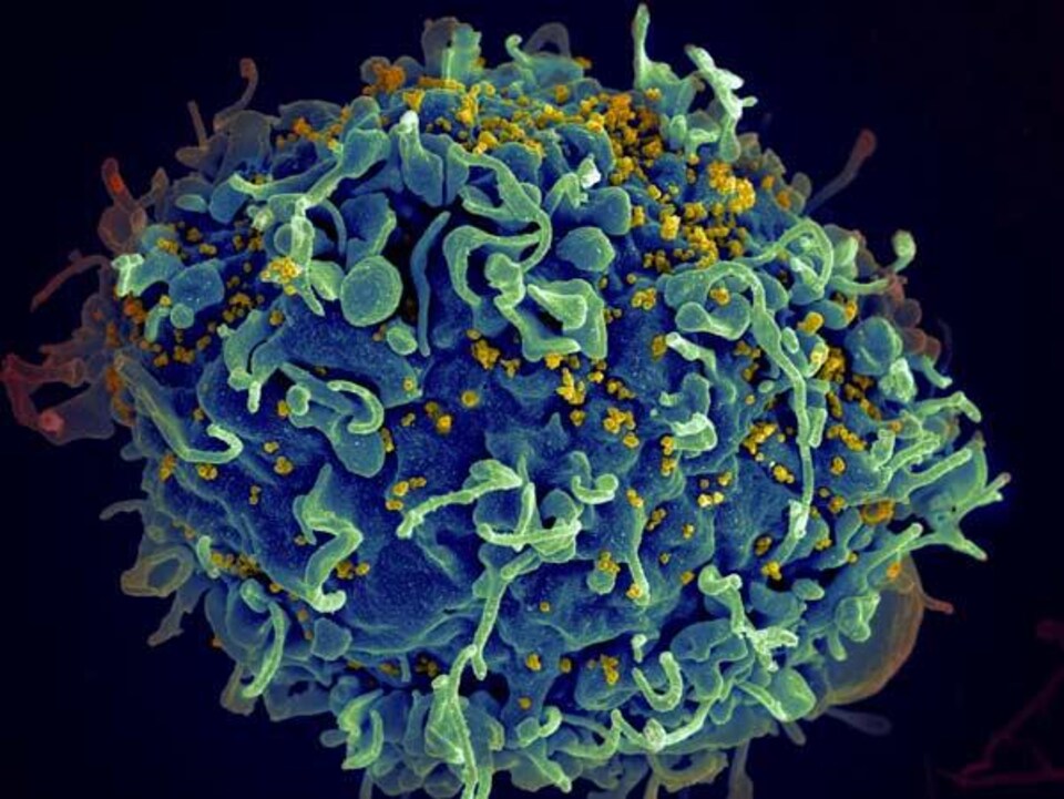 Une cellule immunitaire humaine infectée par le VIH (en jaune).