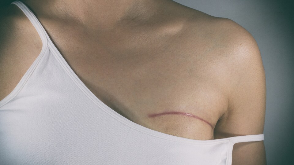Au Québec, seulement 7 % des femmes ayant subi une mastectomie optent pour la reconstruction mammaire. Aux États-Unis et en Europe, cette proportion atteint environ 45 %.