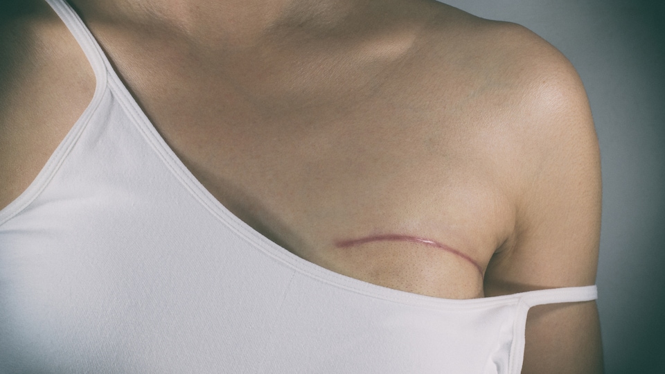 La poitrine d'une femme portant une cicatrice rouge.
