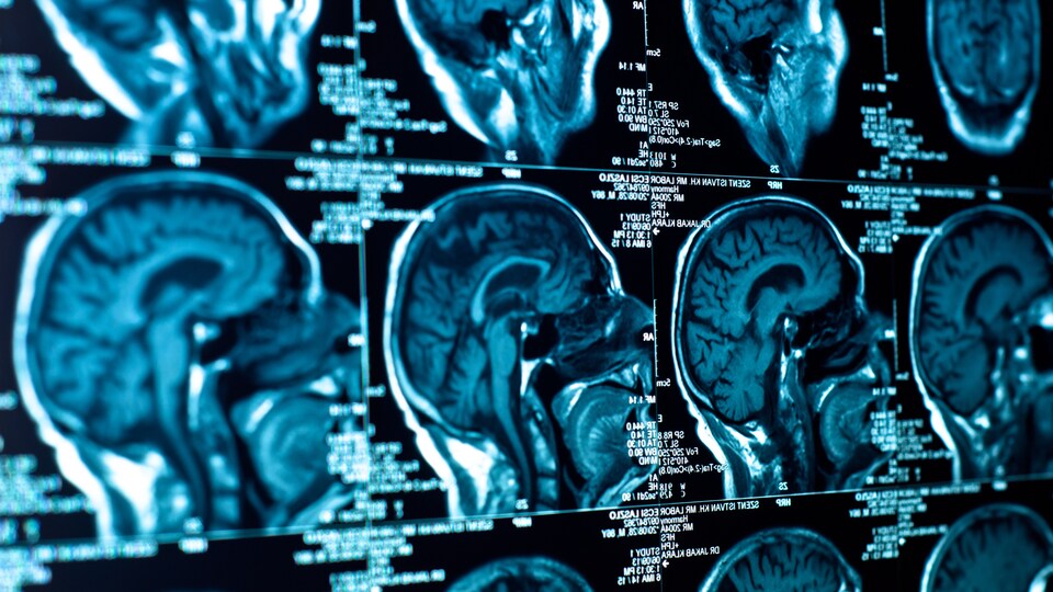 Gros plan d'un CT-scan avec cerveau.