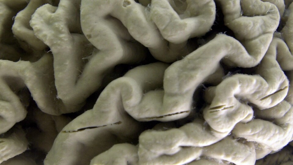 Portion du cerveau d'une personne ayant souffert de la maladie d'Alzheimer.