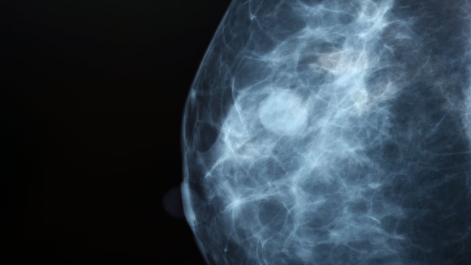 La mammographie d'une femme