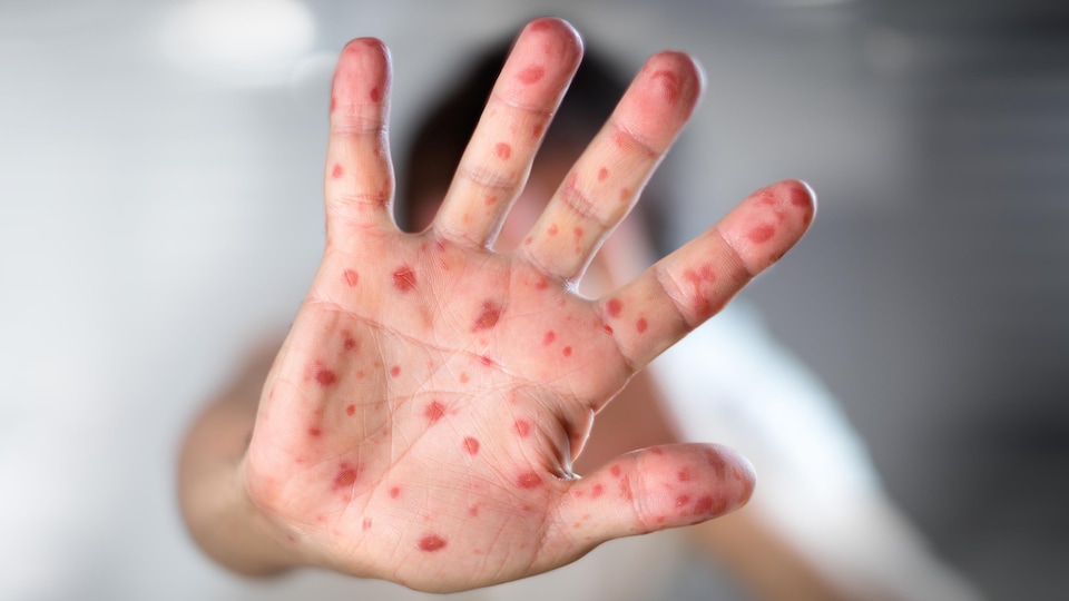 Une main d'enfant montrant des symptômes de la rougeole.