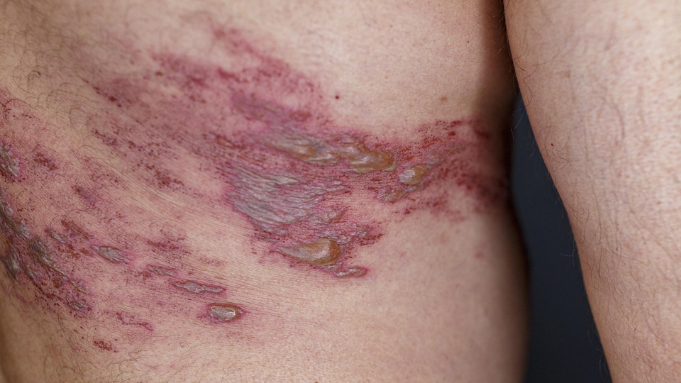 Plan rapproché du dos d'un homme atteint de zona : des lésions cutanées et des rougeurs sont visibles sur sa peau.
