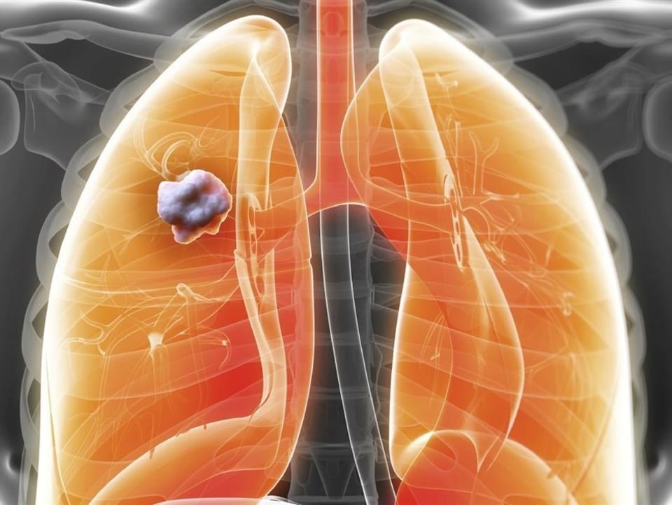 La combustion du kérosène des avions nocive pour les poumons Radio