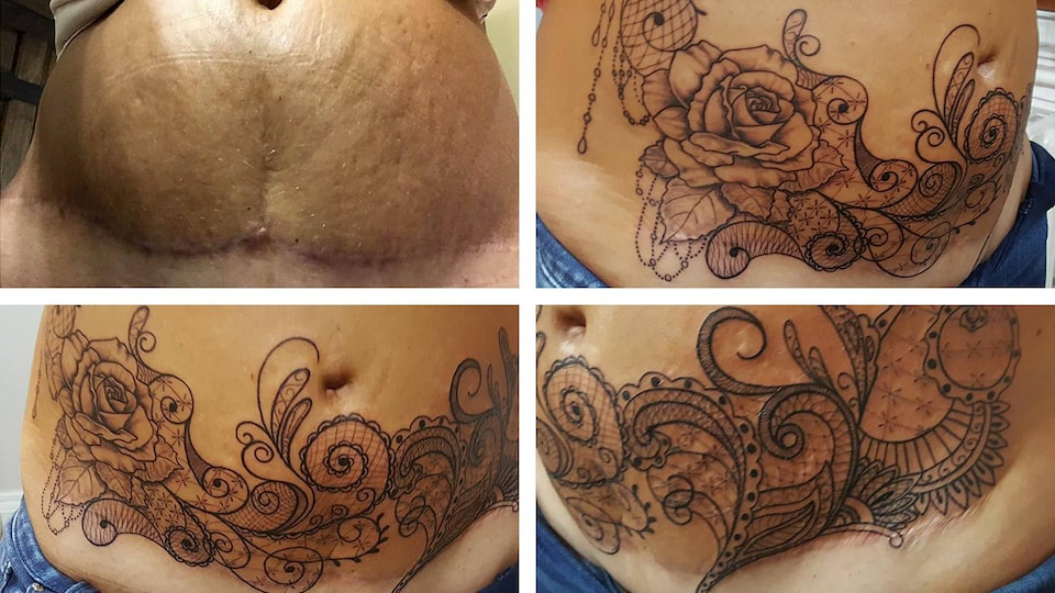 Montage photo « avant, après » d'une cicatrice qui a été tatouée.