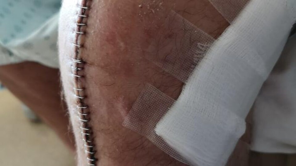 Des points de suture recouvrent le genou de Maxime Lanciault après une opération. 