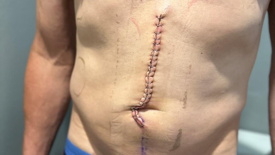 cicatrice sur l'abdomen de Peter Kirkegaard