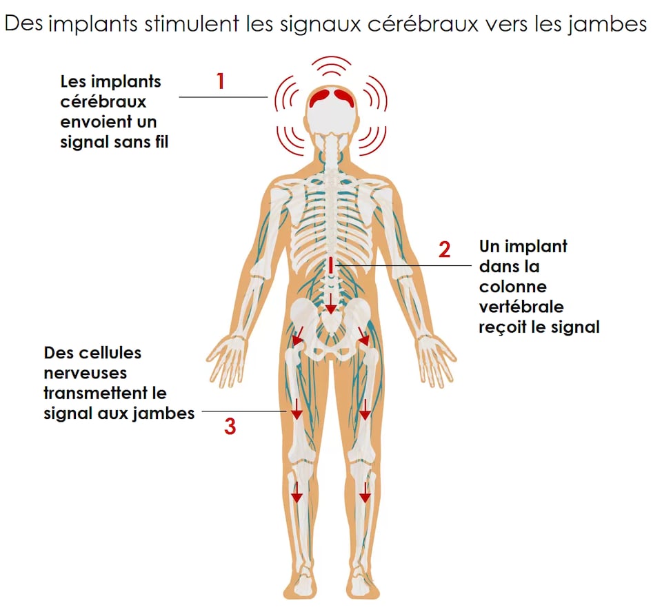 Une illustration du corps humain y compris un squelette et le système nerveux. Le texte suivant explique le fonctionnement des implants qui stimulent les signaux cérébraux vers les jambes. 1) Les implants cérébraux envoient un signal sans fil. 2) Un implant dans la colonne vertébrale reçoit le signal. 3) Des cellules nerveuses transmettent le signal aux jambes.