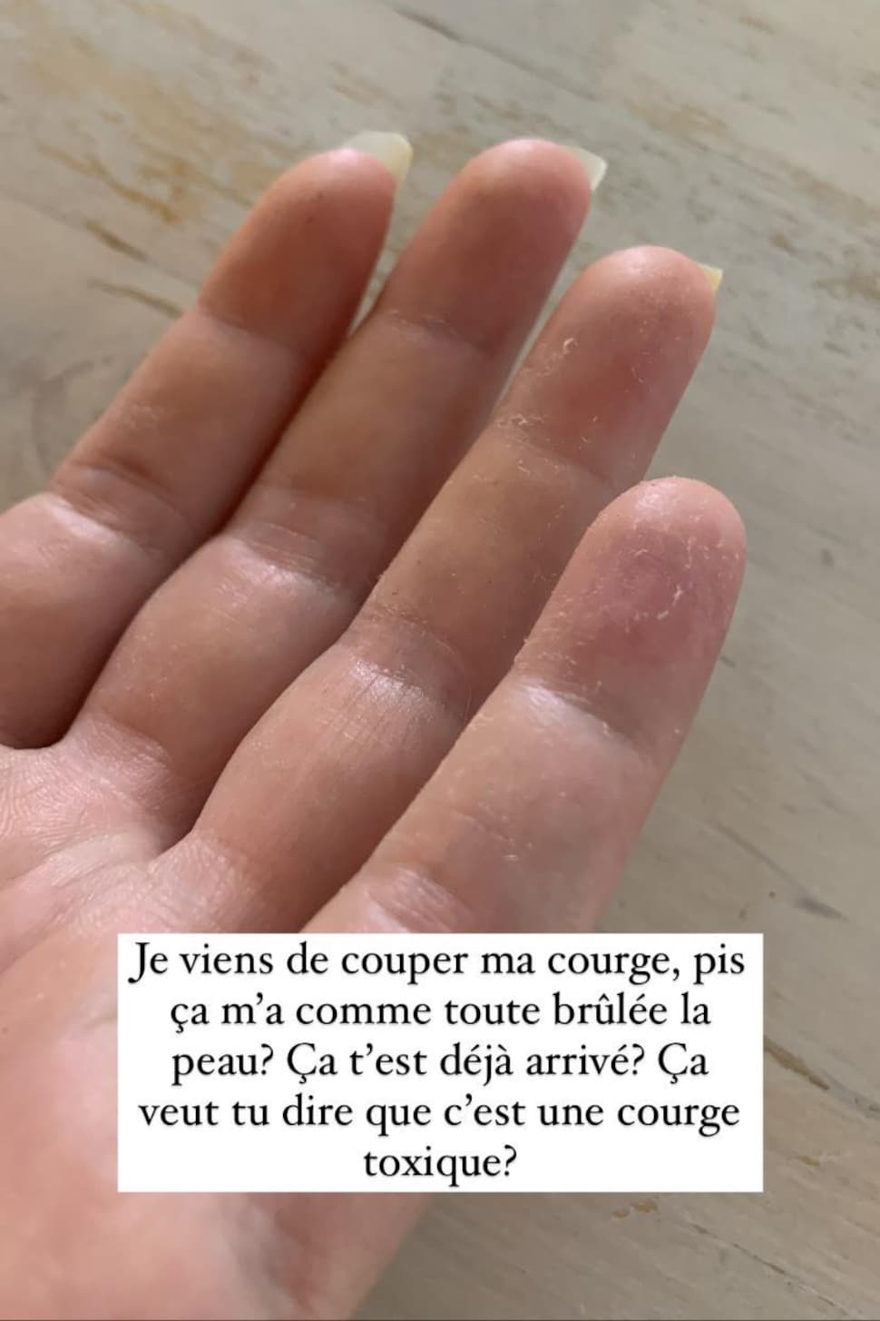 Une photo d'une main avec des rougeurs et la peau qui pèle.