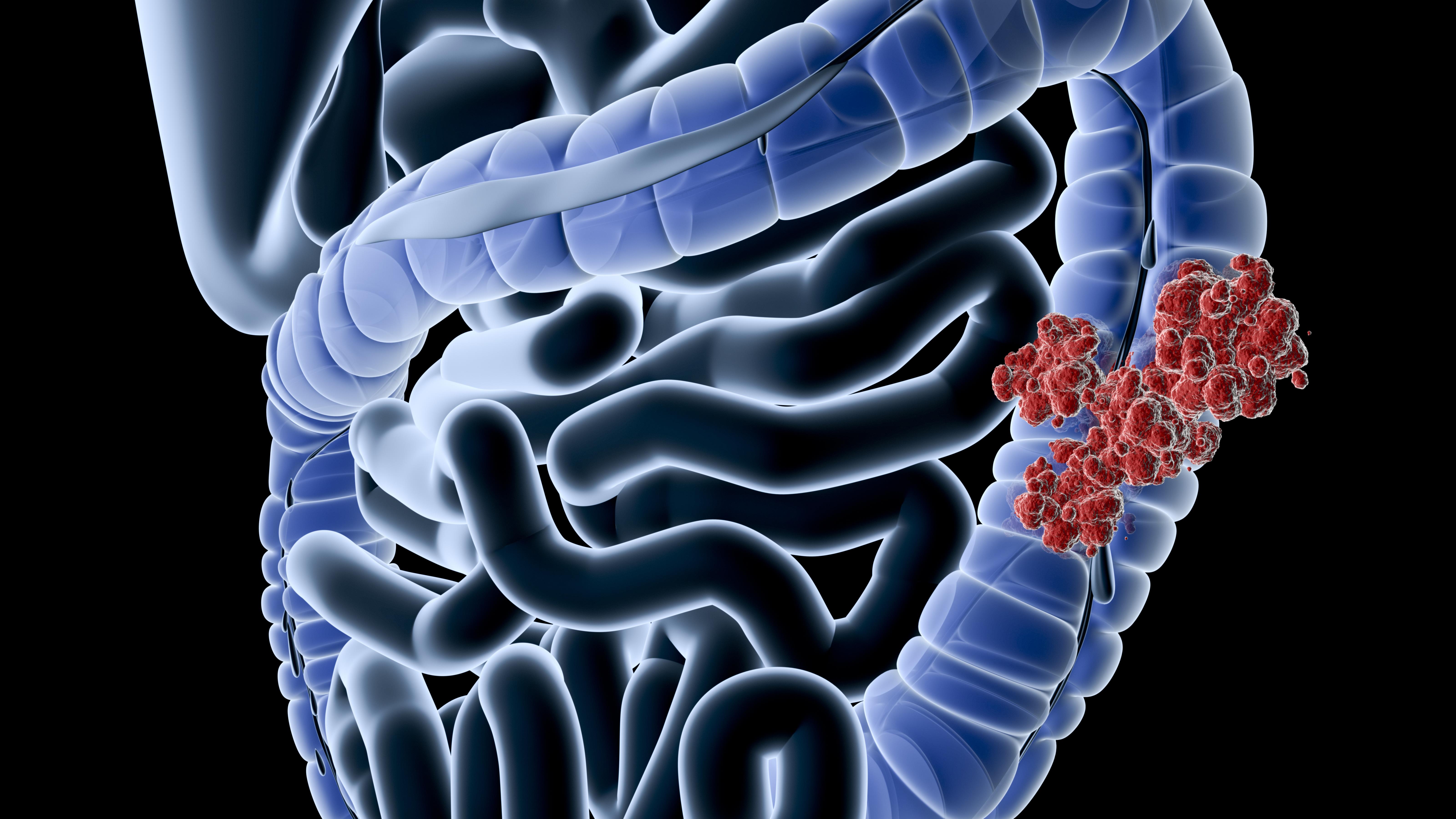 Cancer colorectal jeune adulte Cancer colon jeune, Cancer colorectal jeune homme