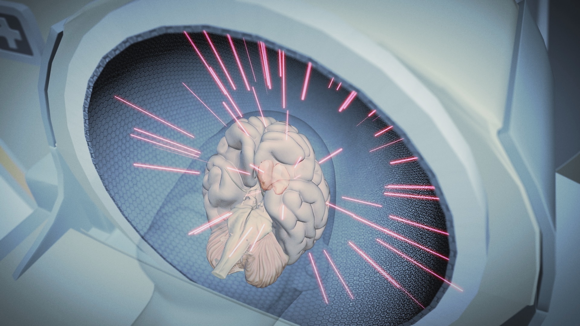 Parkinson : quand la technologie des IRM offre une solution