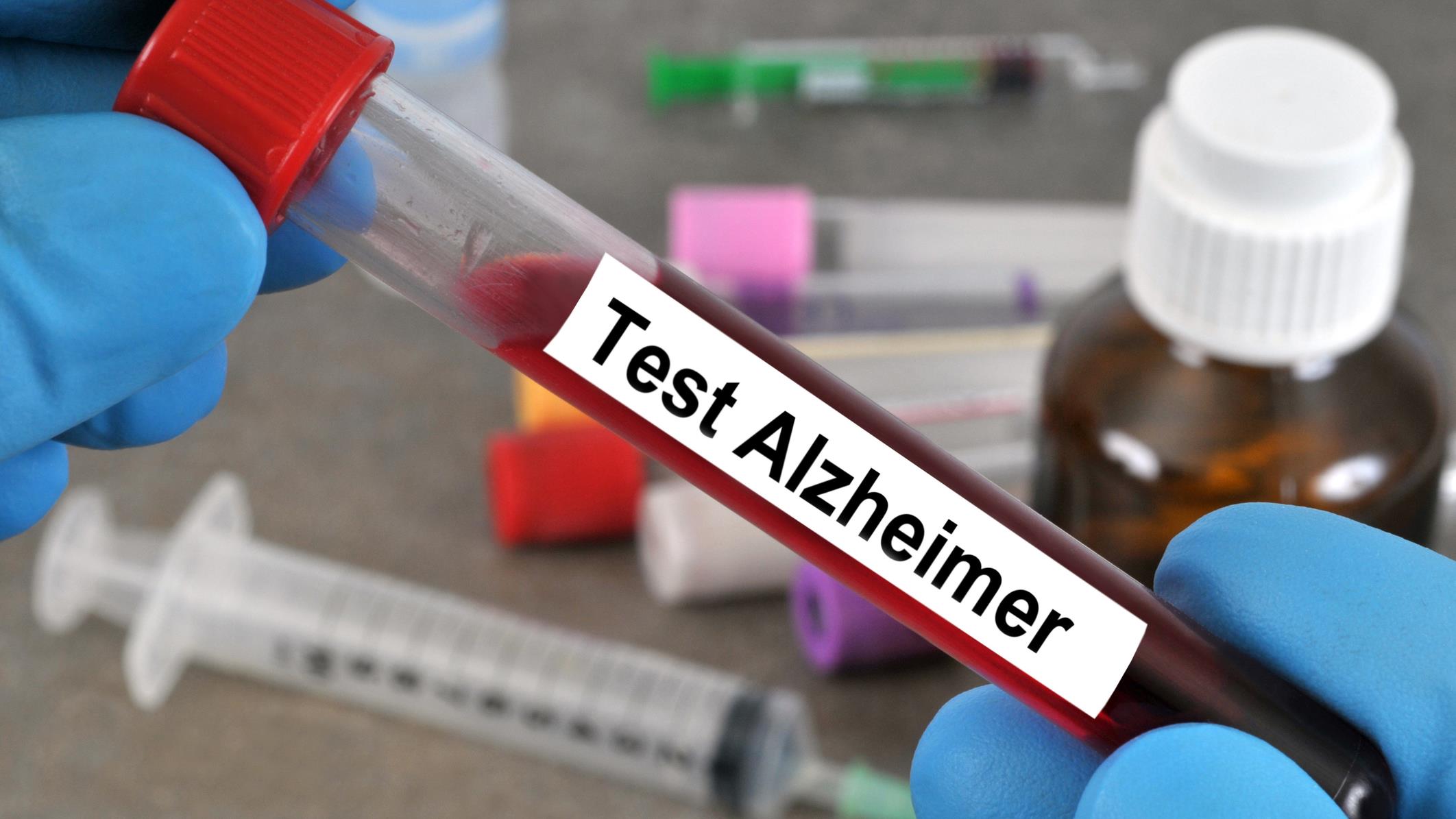 Maladie d’Alzheimer : un nouveau test sanguin porteur d’espoir ?