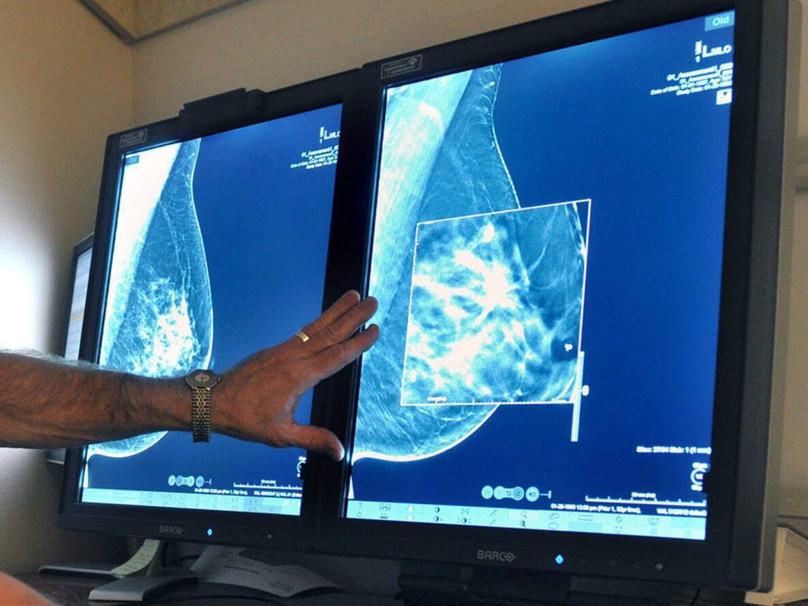 Les tests de dépistage du cancer du sein dès 40 ans? | OHdio | Radio-Canada