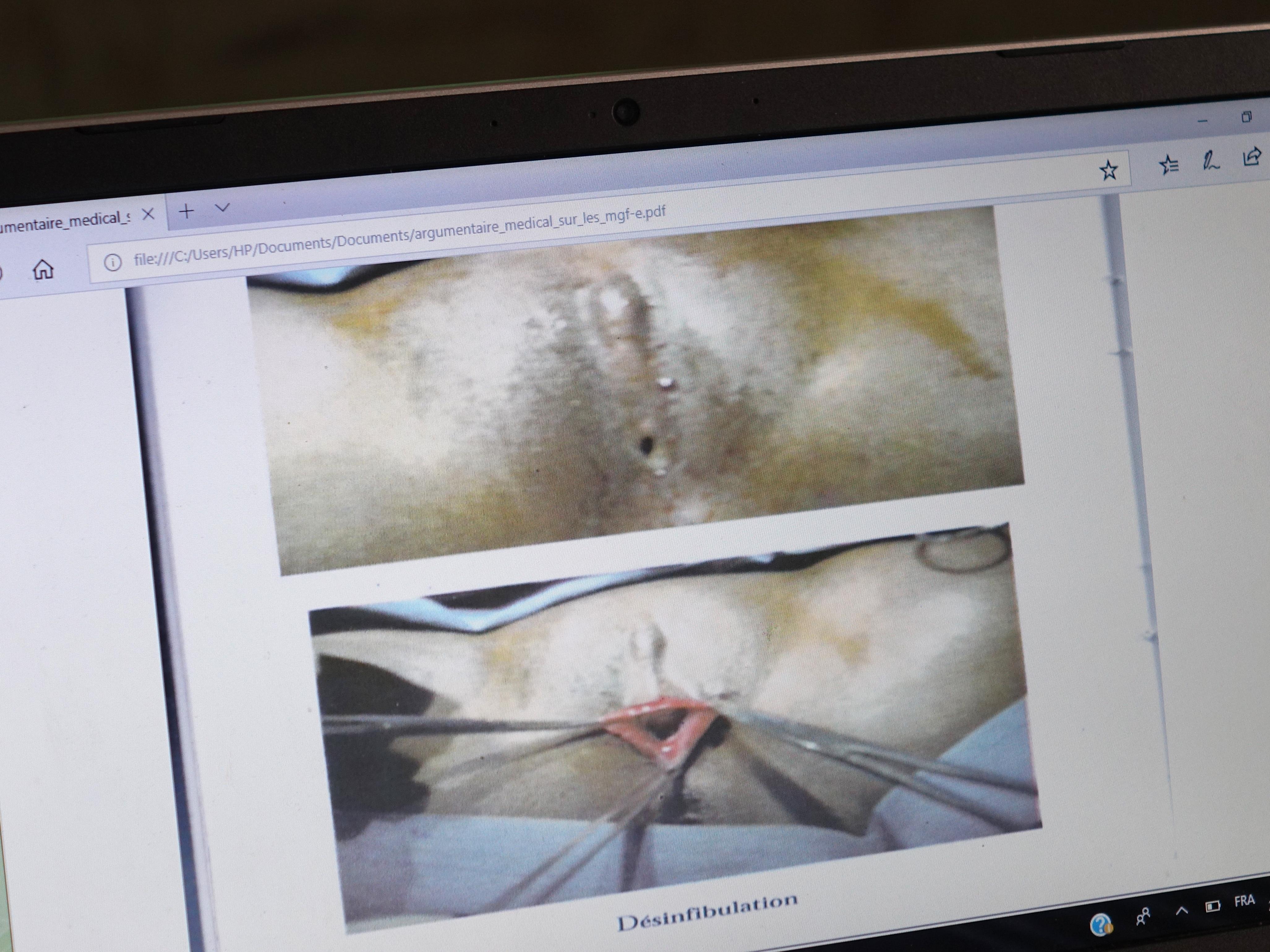 Des images du sexe mutilé d’une femme