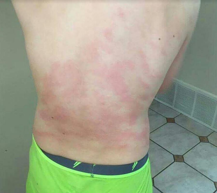 Un garçon de 9 ans est allergique à l'eau RadioCanada.ca