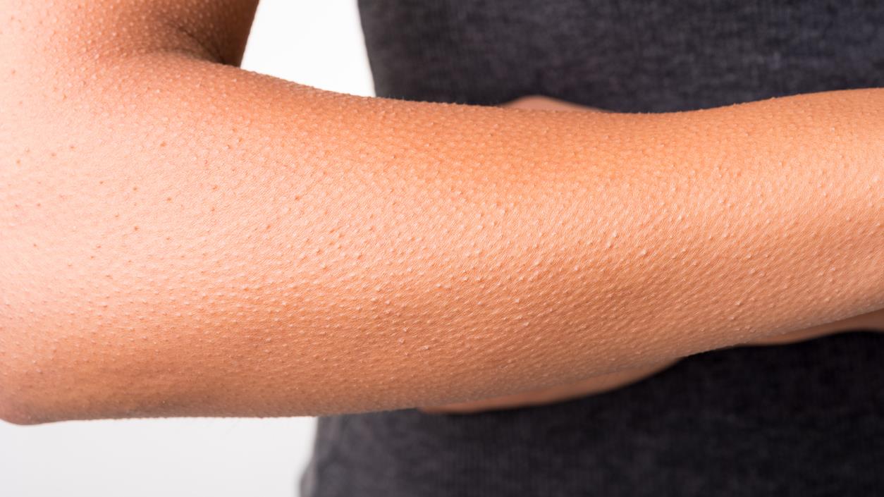 Pourquoi avonsnous la chair de poule?