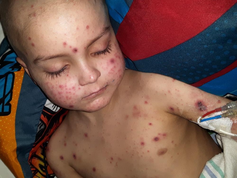 Le petit Guillaume, couché, a la peau recouverte de boutons