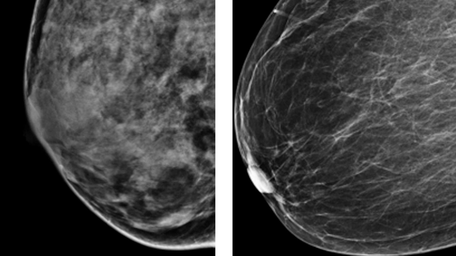 Résultats comparatifs en noir et blanc de mammographies d'un sein très dense et d'un autre moins dense. Résultats comparatifs en noir et blanc de mammographies d'un sein très dense et d'un autre moins dense.