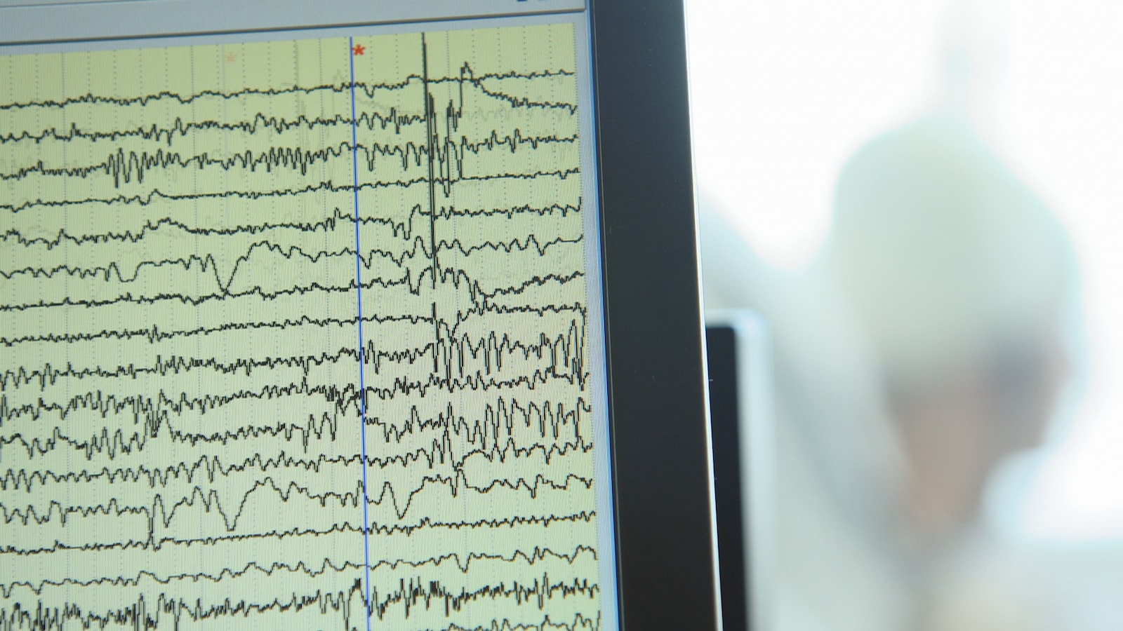 Électroencéphalogramme intracrânien Électroencéphalogramme intracrânien