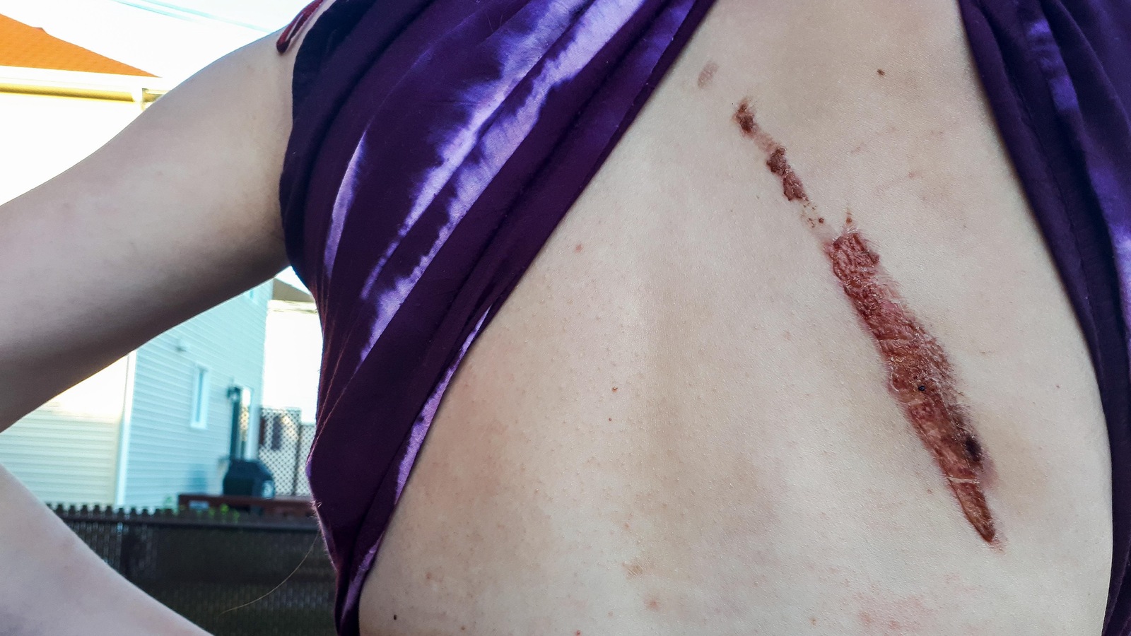 Jasmine Huot-McCann montre le blessure qu'elle a subie au dos lors d'un accident à Porto Rico Jasmine Huot-McCann montre le blessure qu'elle a subie au dos lors d'un accident à Porto Rico