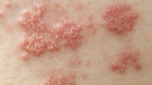 Shingles patches appear on a person's skin.