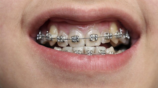 Des broches orthodontiques.