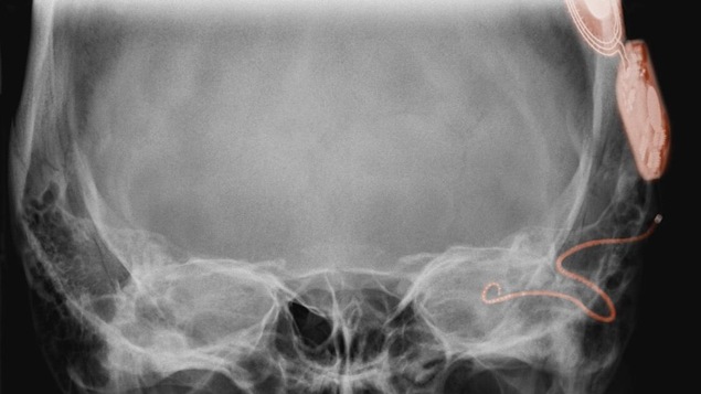 Radiographie d'un implant cochléaire