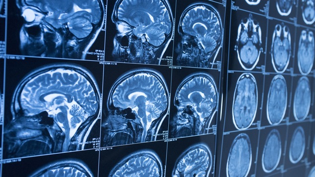 IRM du cerveau