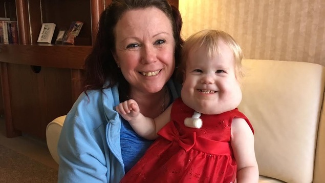 Une maman et sa petite fille atteinte d'une anomalie congénitale. Une maman et sa petite fille atteinte d'une anomalie congénitale.